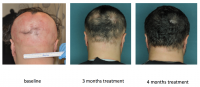 alopecia-areata-clinical-trial-columbia